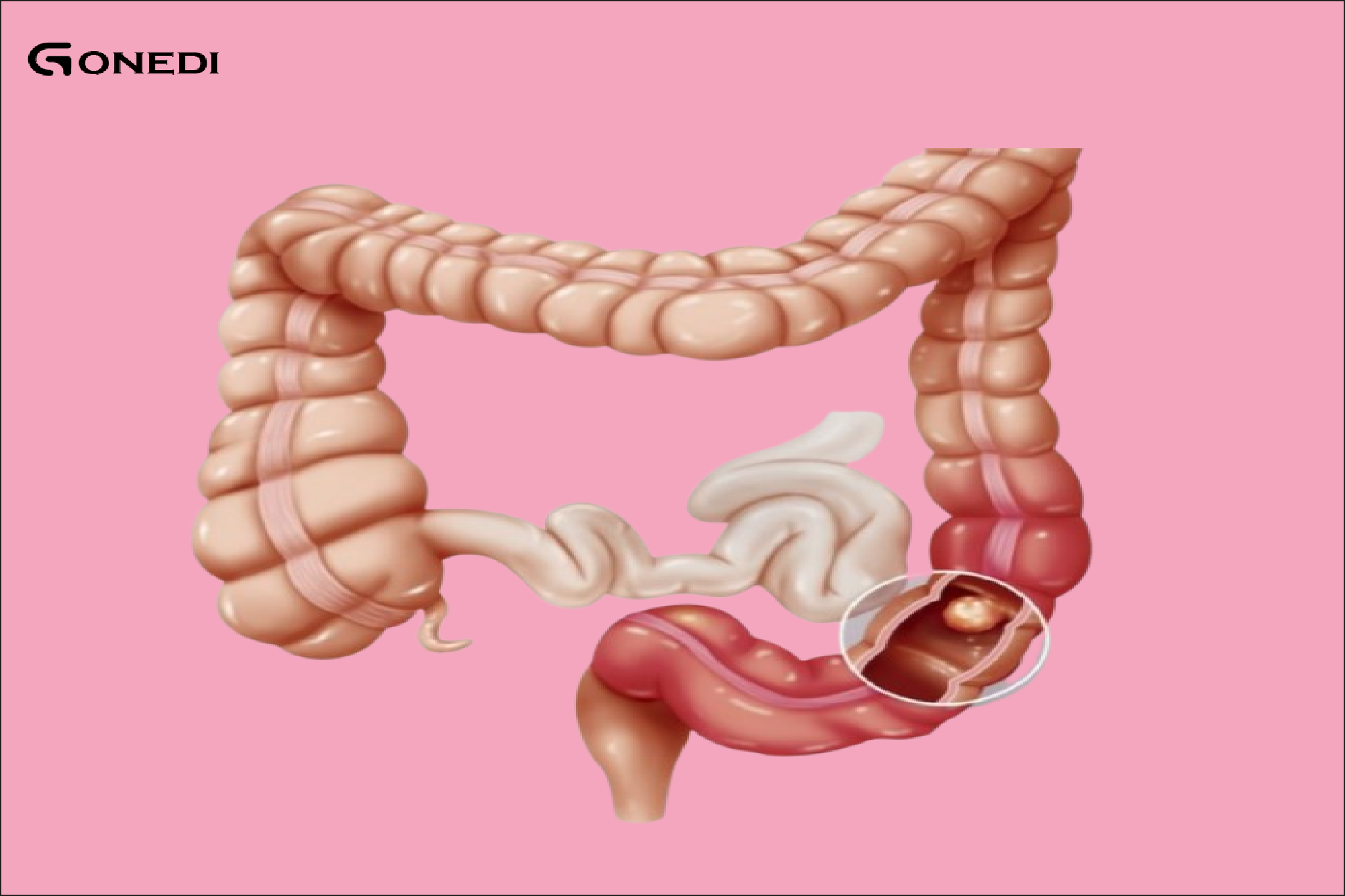 6 overlooked signs of colon cancer