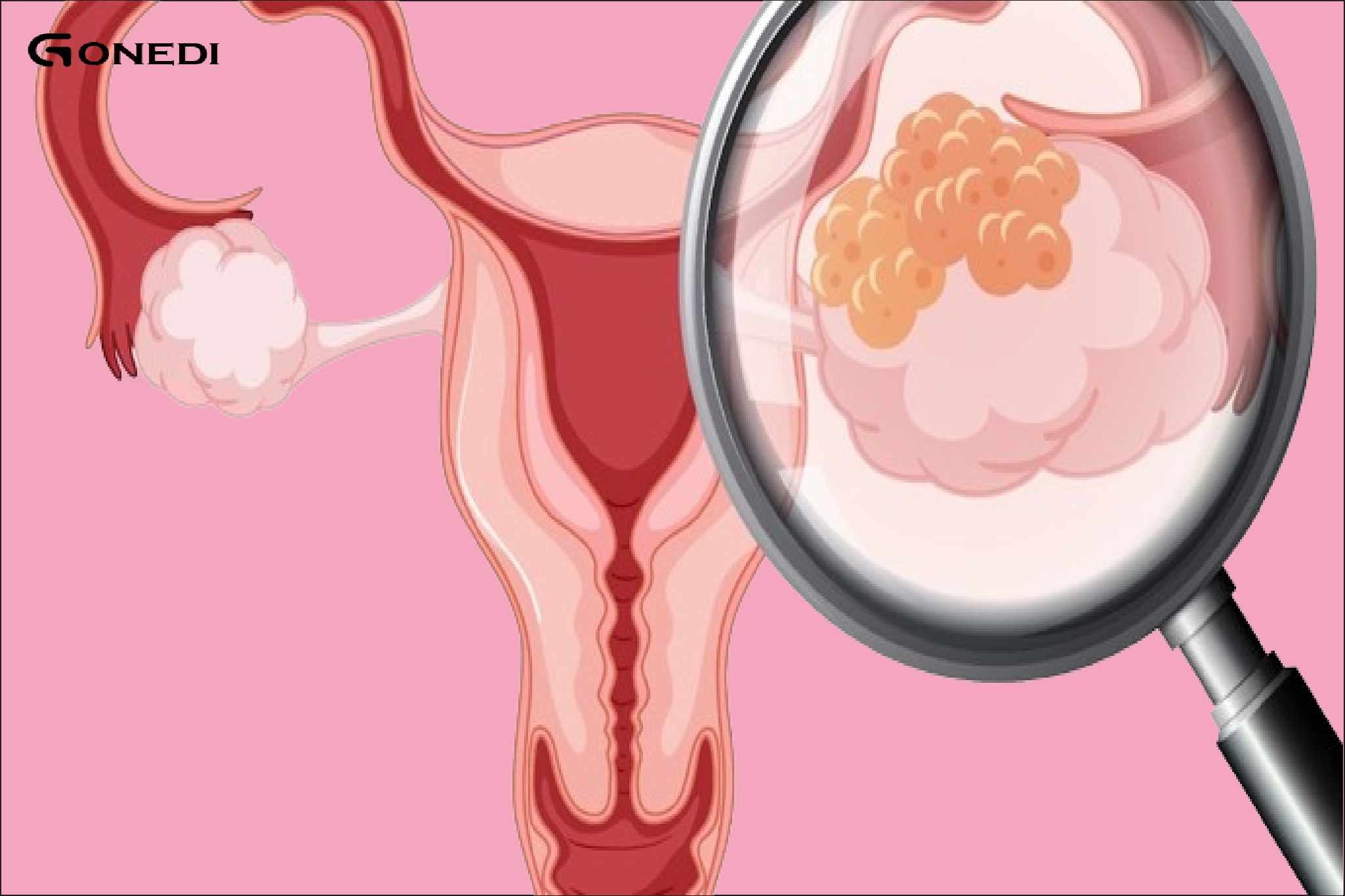 Early warning signs of ovarian cancer every woman should know