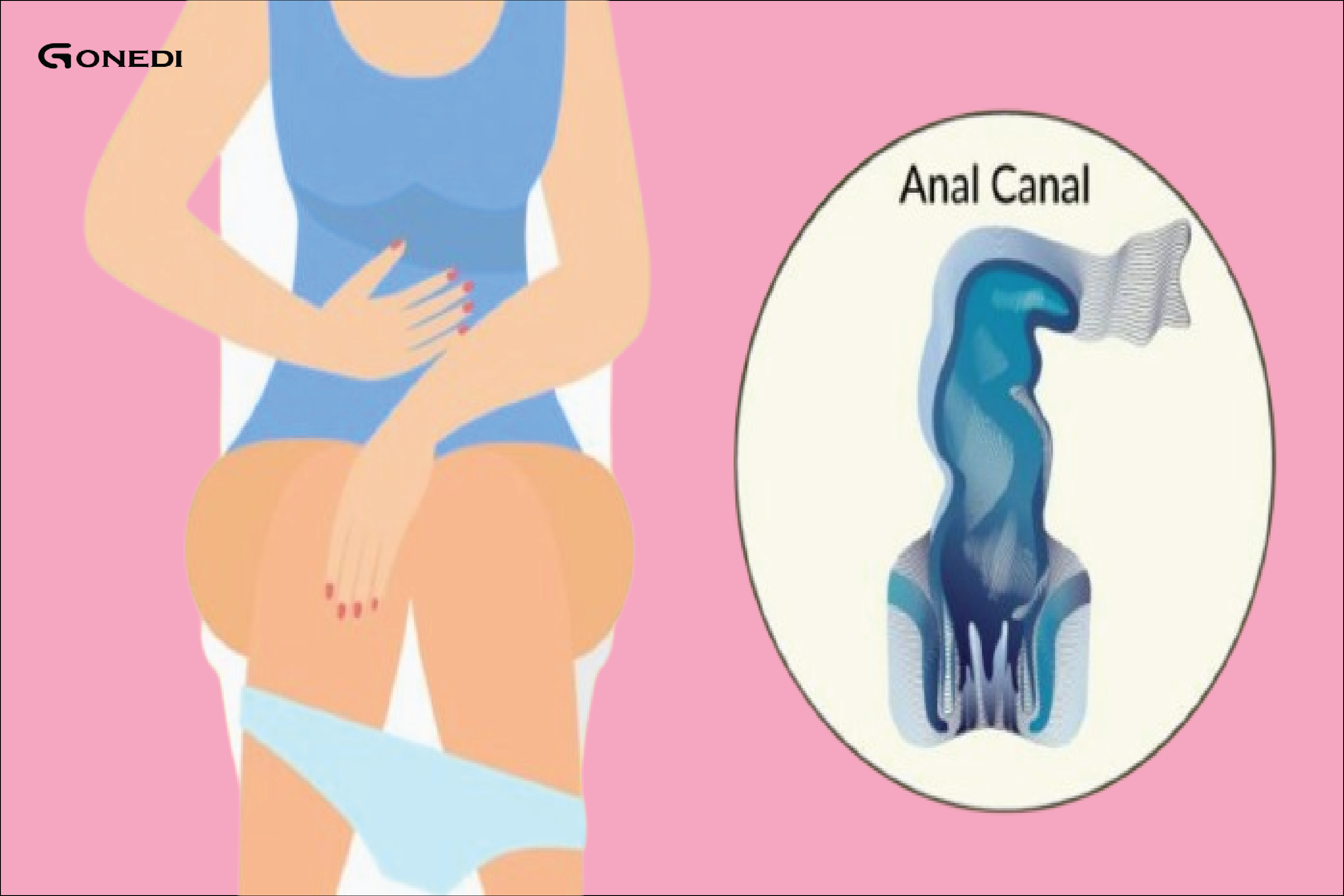 5 early warning signs of anal cancer that you shouldn’t feel embarrassed to talk about