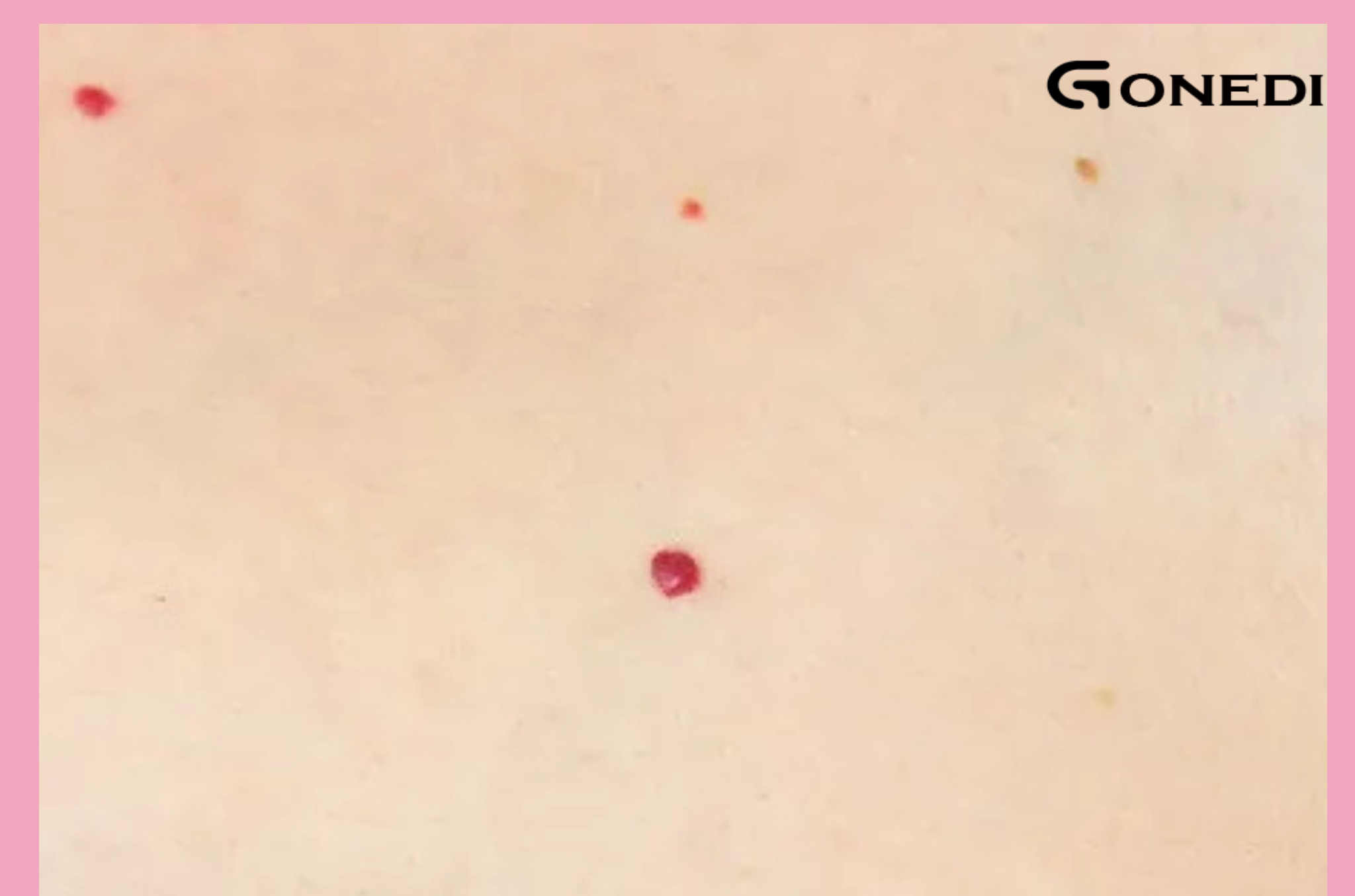 What do these red dots on your skin mean?